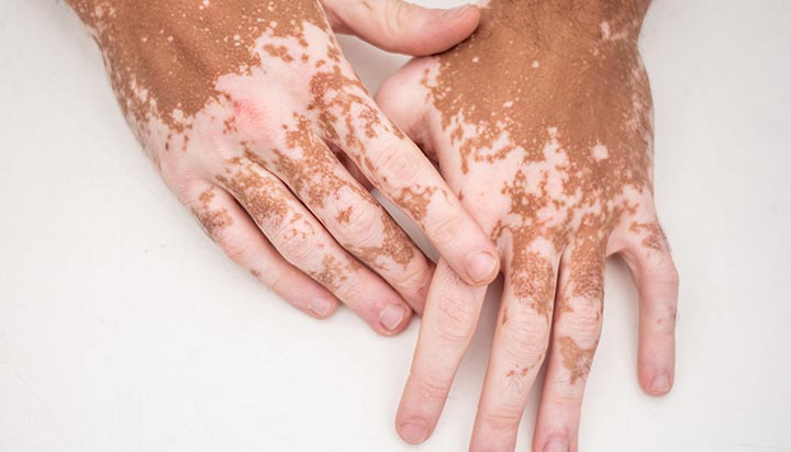 Vitiligo Treatment